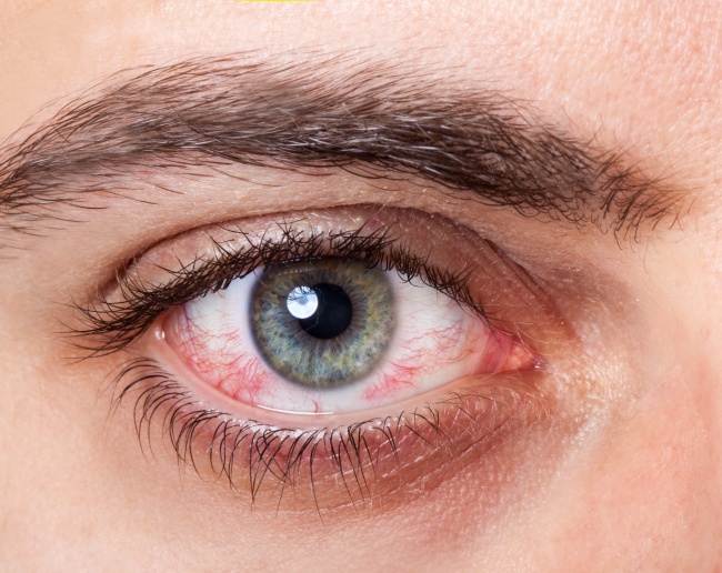 Các vòng trắng quanh giác mạc là biểu hiện của bệnh mắt