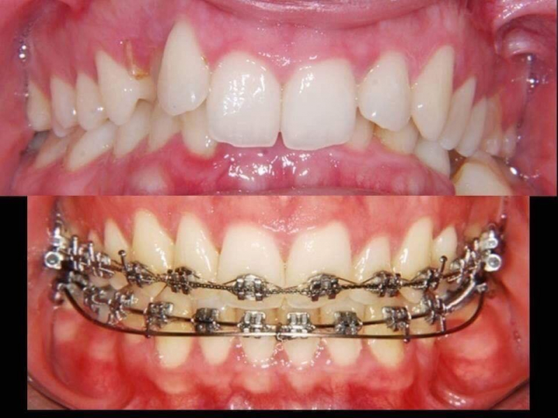 Niềng răng và điều chỉnh răng cho nụ cười đẹp hơn